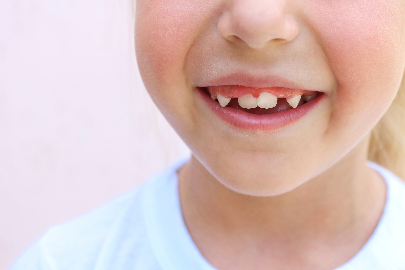 Do Baby Teeth Come in Crooked? Discover the Truth Behind Crooked Baby Teeth