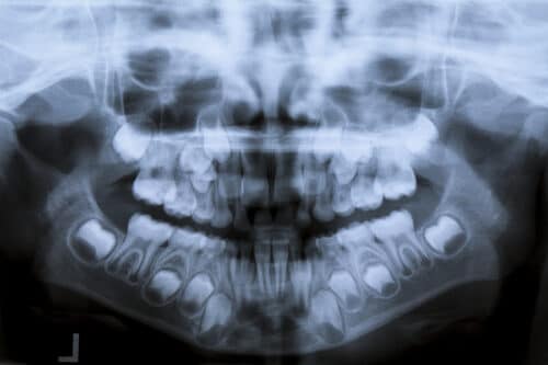 pediatric dental x-ray